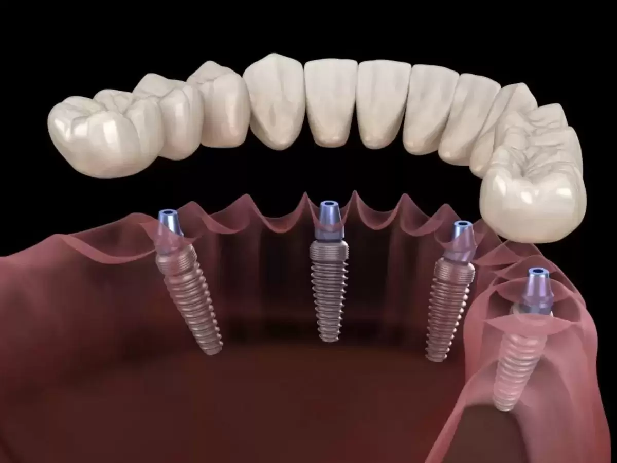 Dental Implants