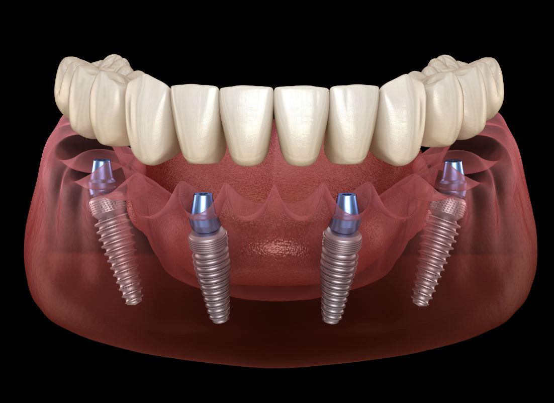 Dental Implants in Manassas